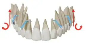 Figura 6. Biomecánica de la intrusión