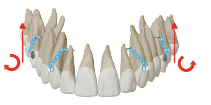 Figure6 La biomeccanica dell'intrusione