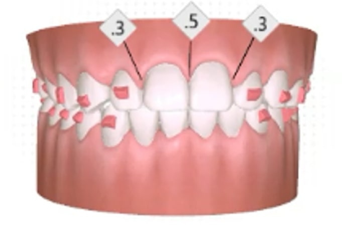 A digital illustration of human teeth showing gaps between the upper front teeth, labeled with measurements 0.3 and 0.5, likely indicating spacing or reduction amounts.
