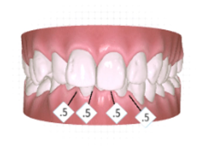 A digital illustration of upper and lower teeth showing four front teeth with labels indicating .5 below each, suggesting measurements or spacing adjustments.