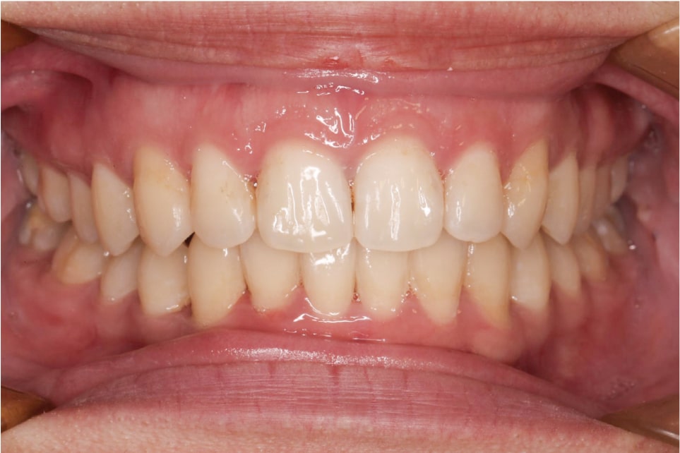Close-up view of a persons mouth showing upper and lower teeth and gums. The lips are pulled back to clearly display the arrangement and condition of the teeth and surrounding gum tissue.
