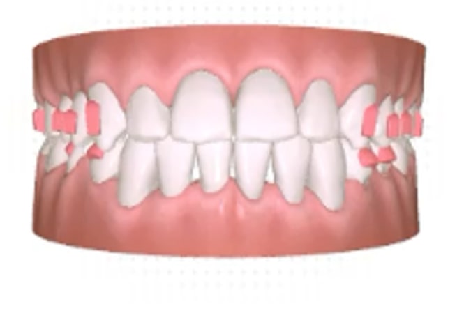 A digital illustration of teeth showing severe crowding and misalignment in both the upper and lower jaws, with gums partially visible.