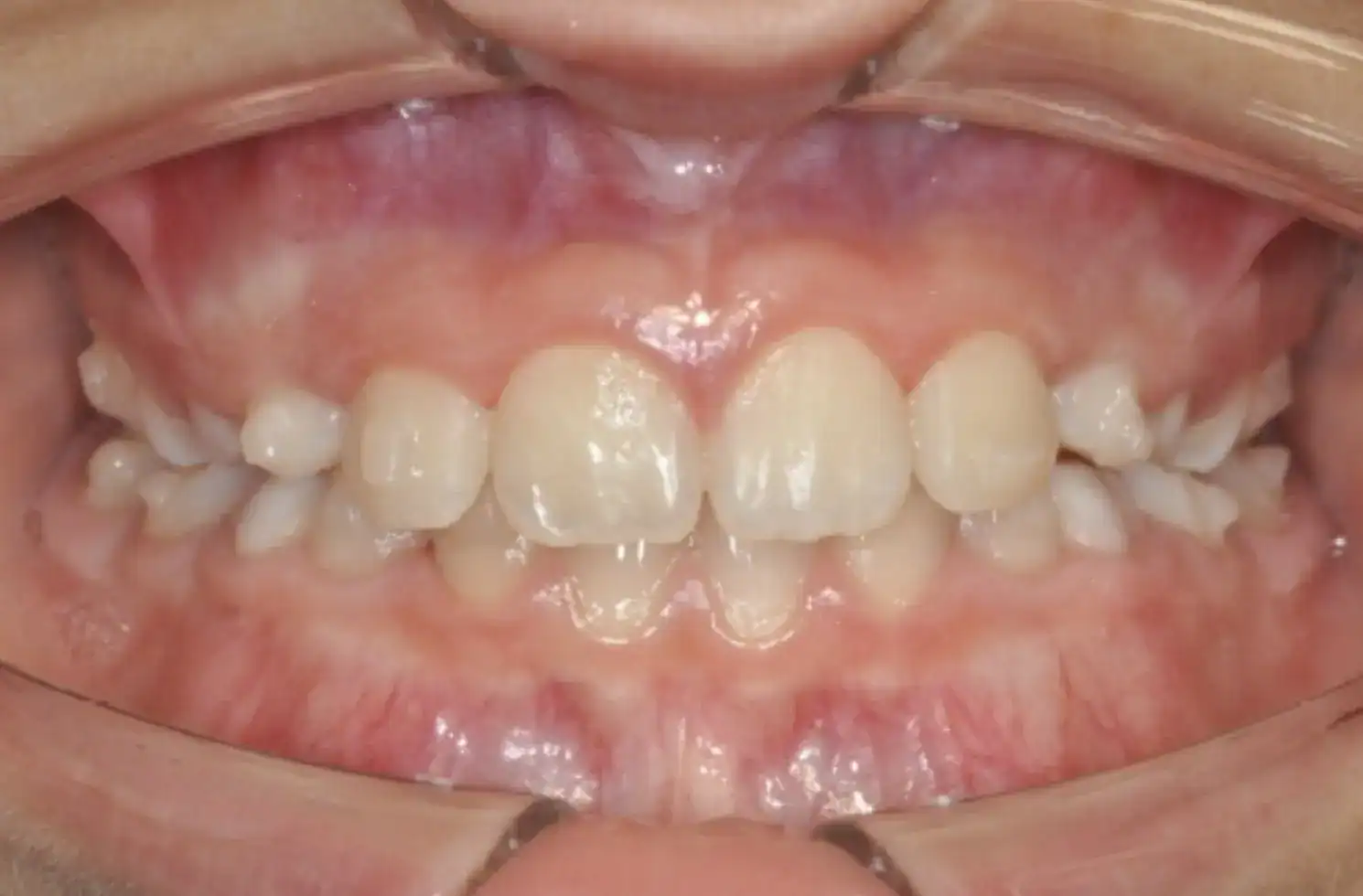 A6 Correction of Mandibular Retrusion in Growth phase patient