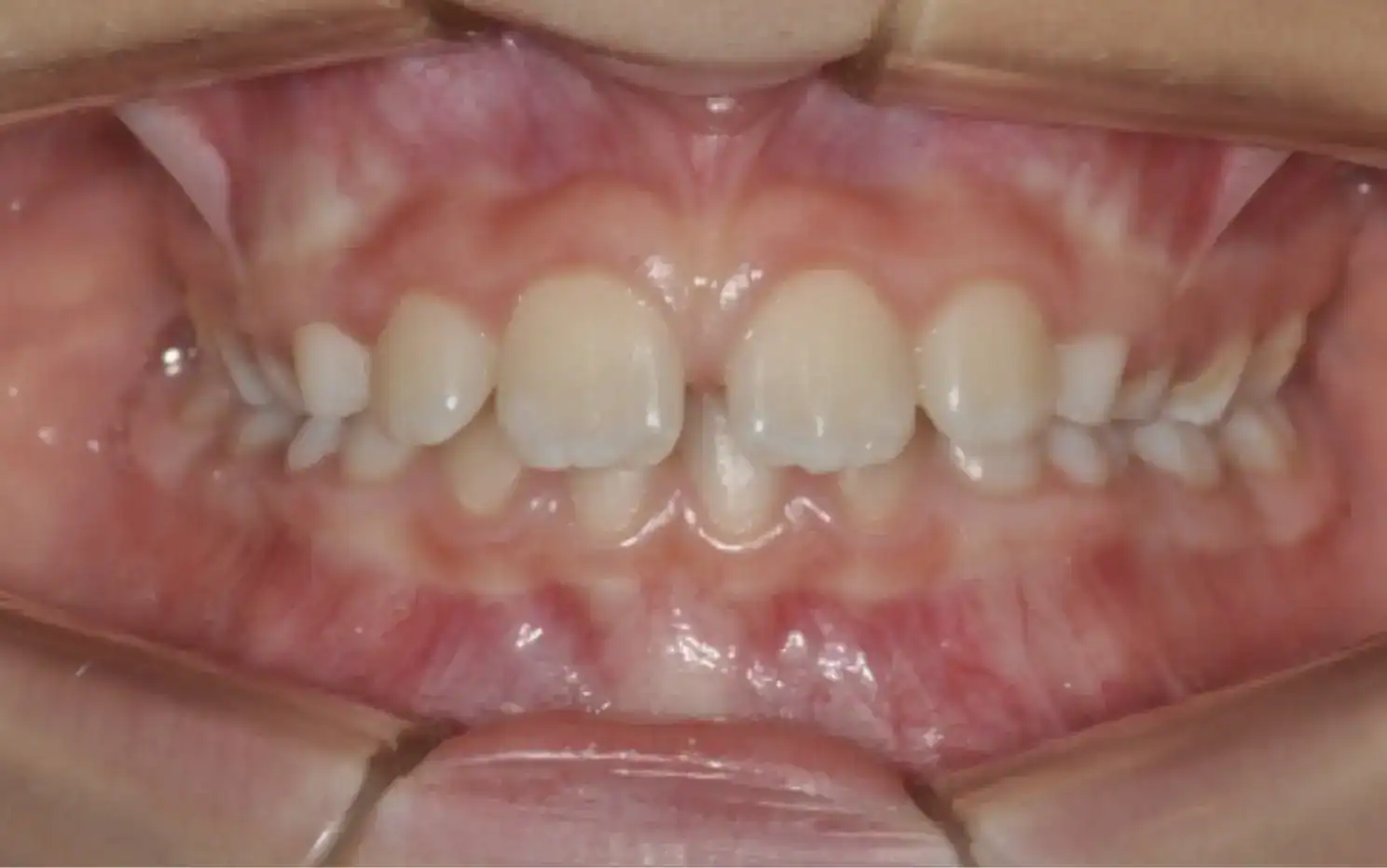 Dental spaces, Teeth forward, Incompetent lips