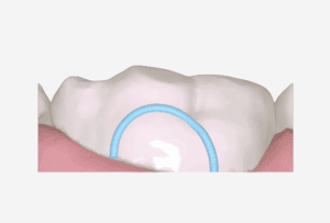 Button Cutout