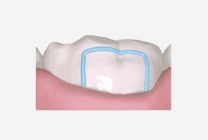 Bracket Cutout