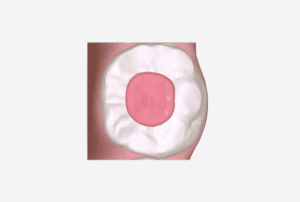 Occlusal Pad