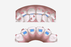 Occlusal Ramps