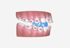 A6 Occlusal Block