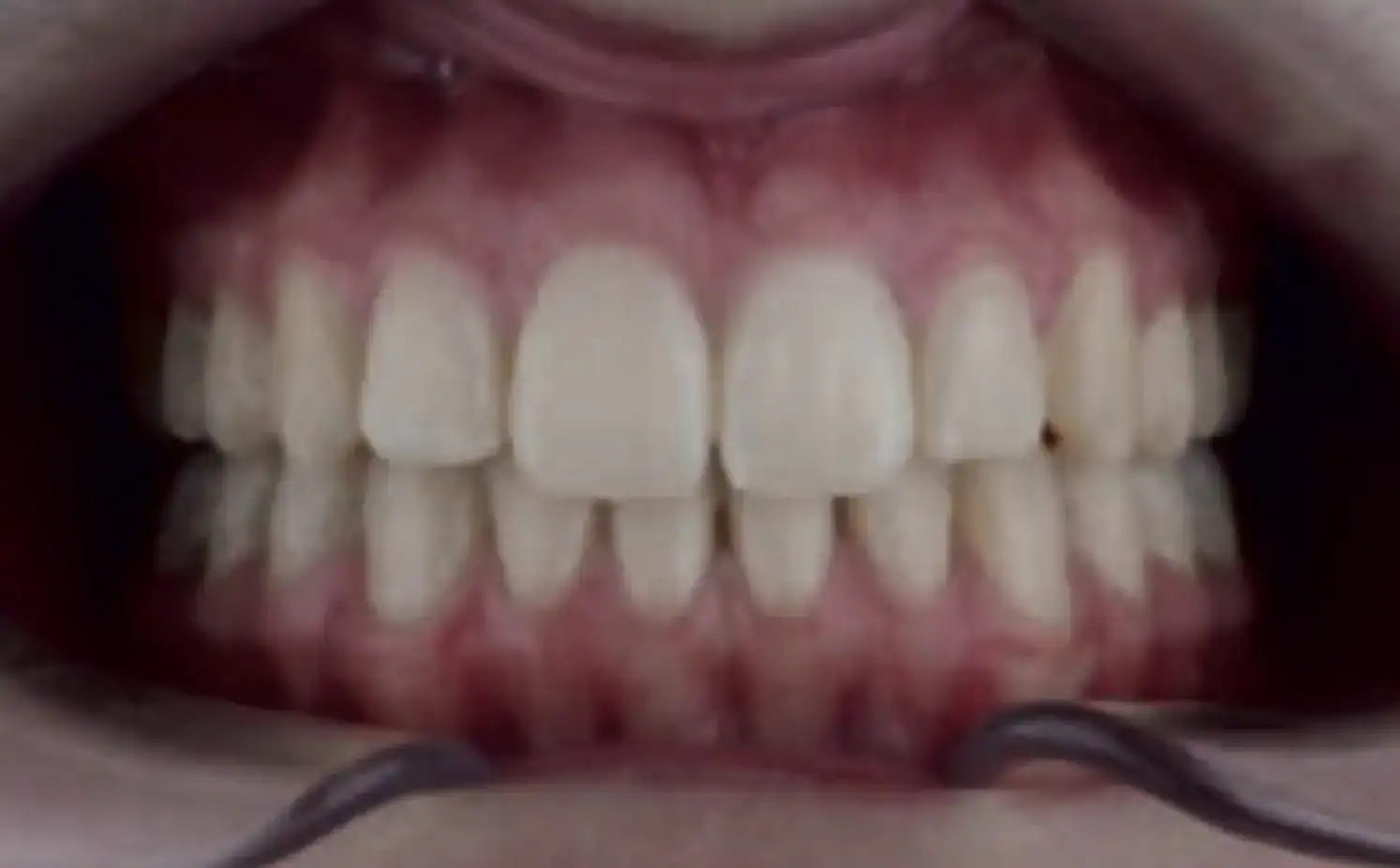 A8 Molar Distalization