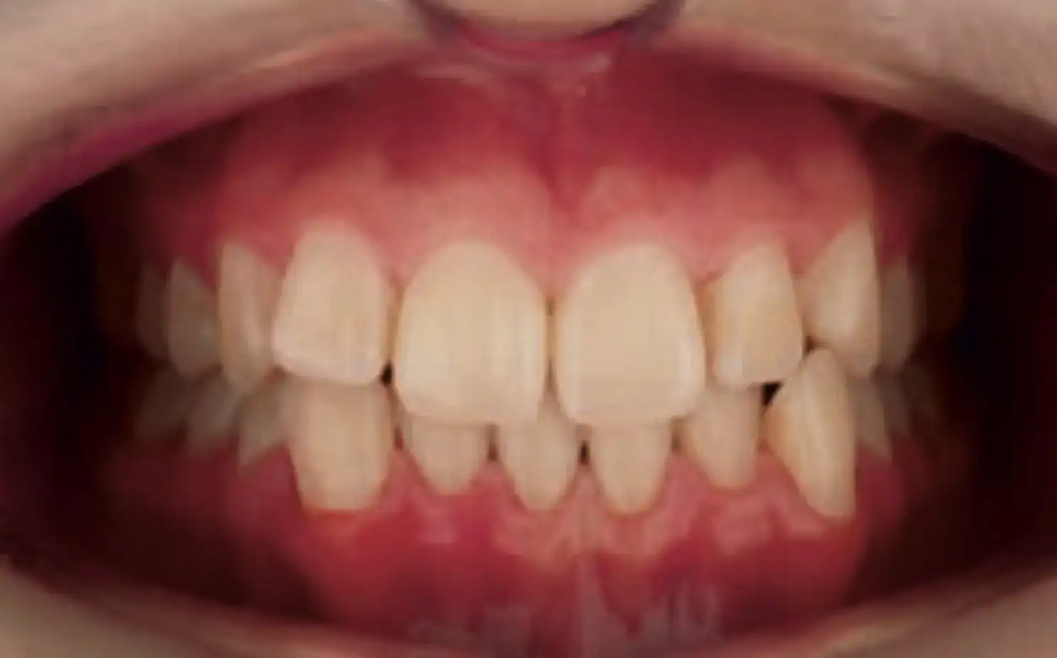 Class III, Deep-bite, Cross-bite, Lower Distalization