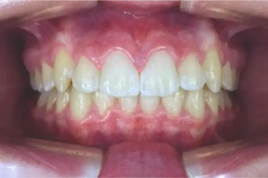 A8 protocol and an asymmetric virtual jump achieved crowding resolution, bite correction, and improved facial profile