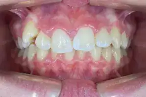 class II malocclusion with upper distalization