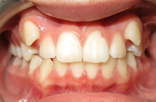 class II div 1 malocclusion