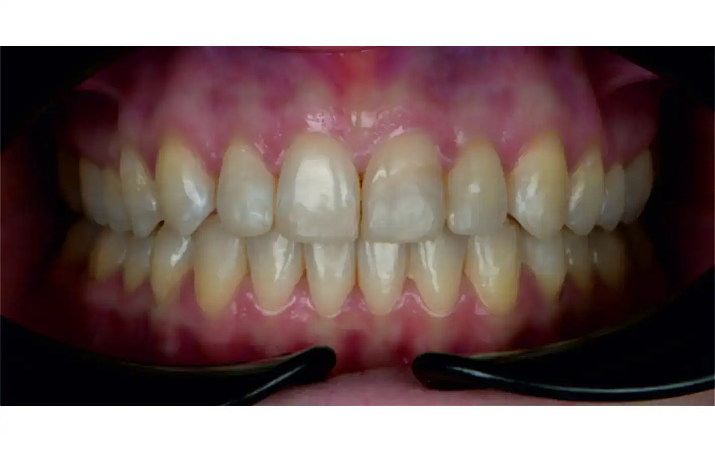 derotation of molars, midline correction, open-bite closure, and Class I settling