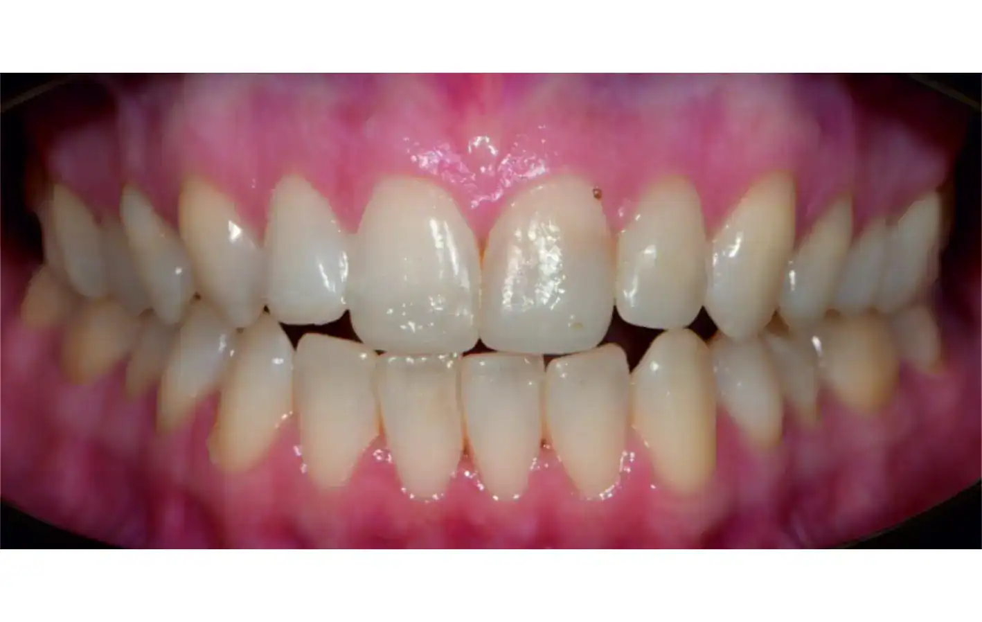 class II div 1 malocclusion
