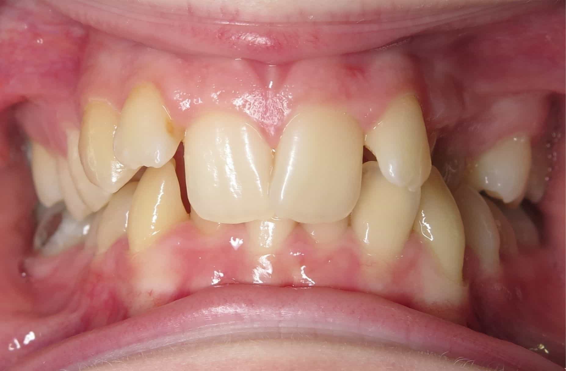 class II div 2 malocclusion