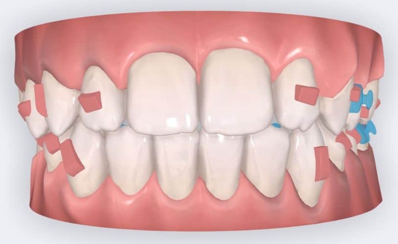 IB frontal view