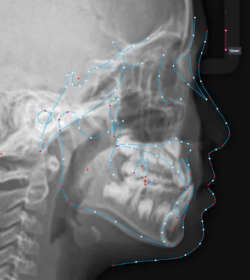 Automated Cephalometic Tracing Automated Cephalometic Tracing