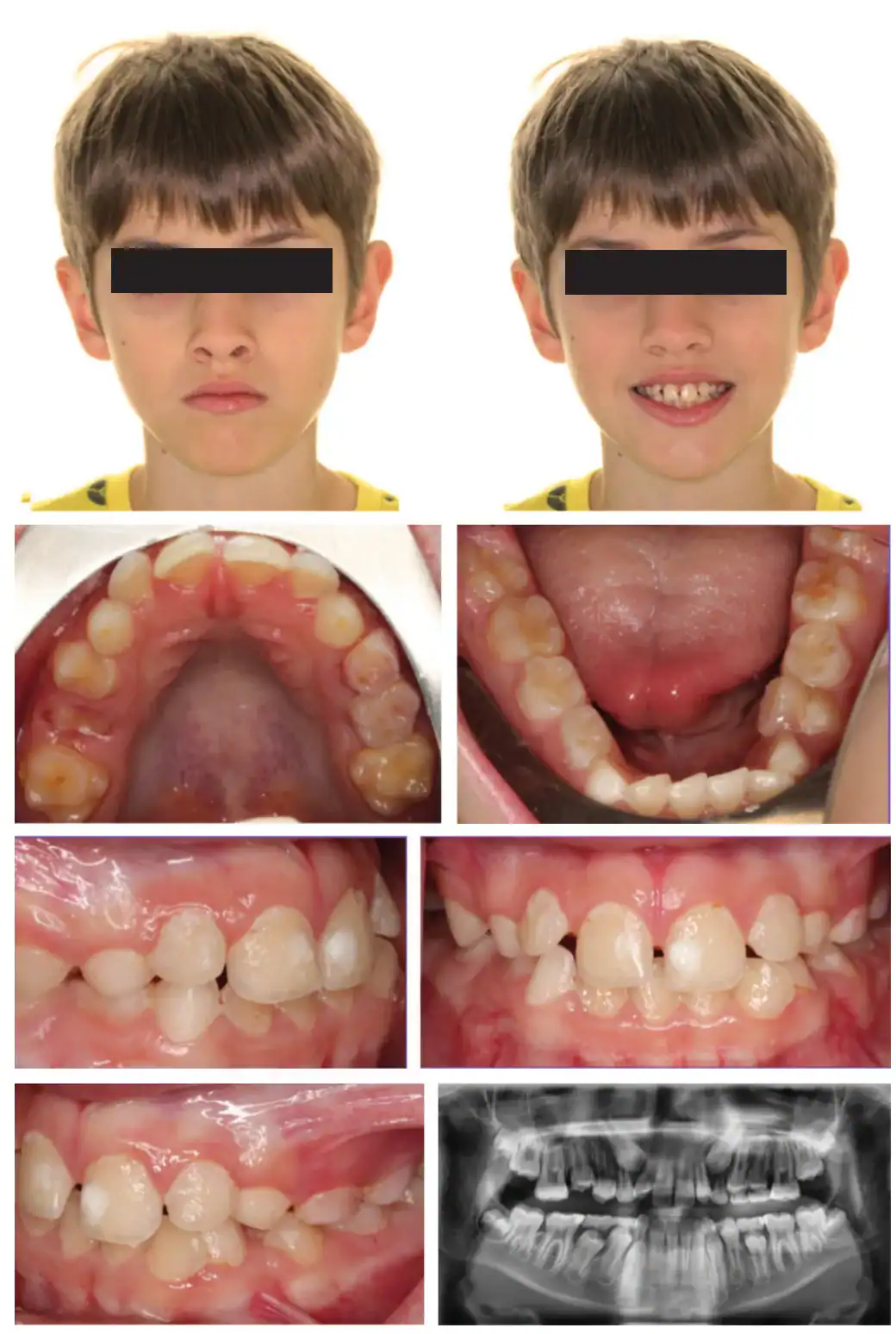 Emerick-Figure-1-JA-initial-photos.png Figure 1: JA initial photos. Mixed dentition, Class I, upper spacing, lower crowding, ectopic U3s (10.7 years old)