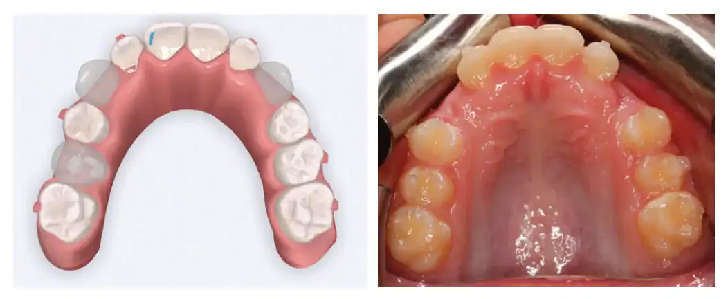 Emerick-Figure-3-Upper-occlusal-of-the-initial-set-up.png