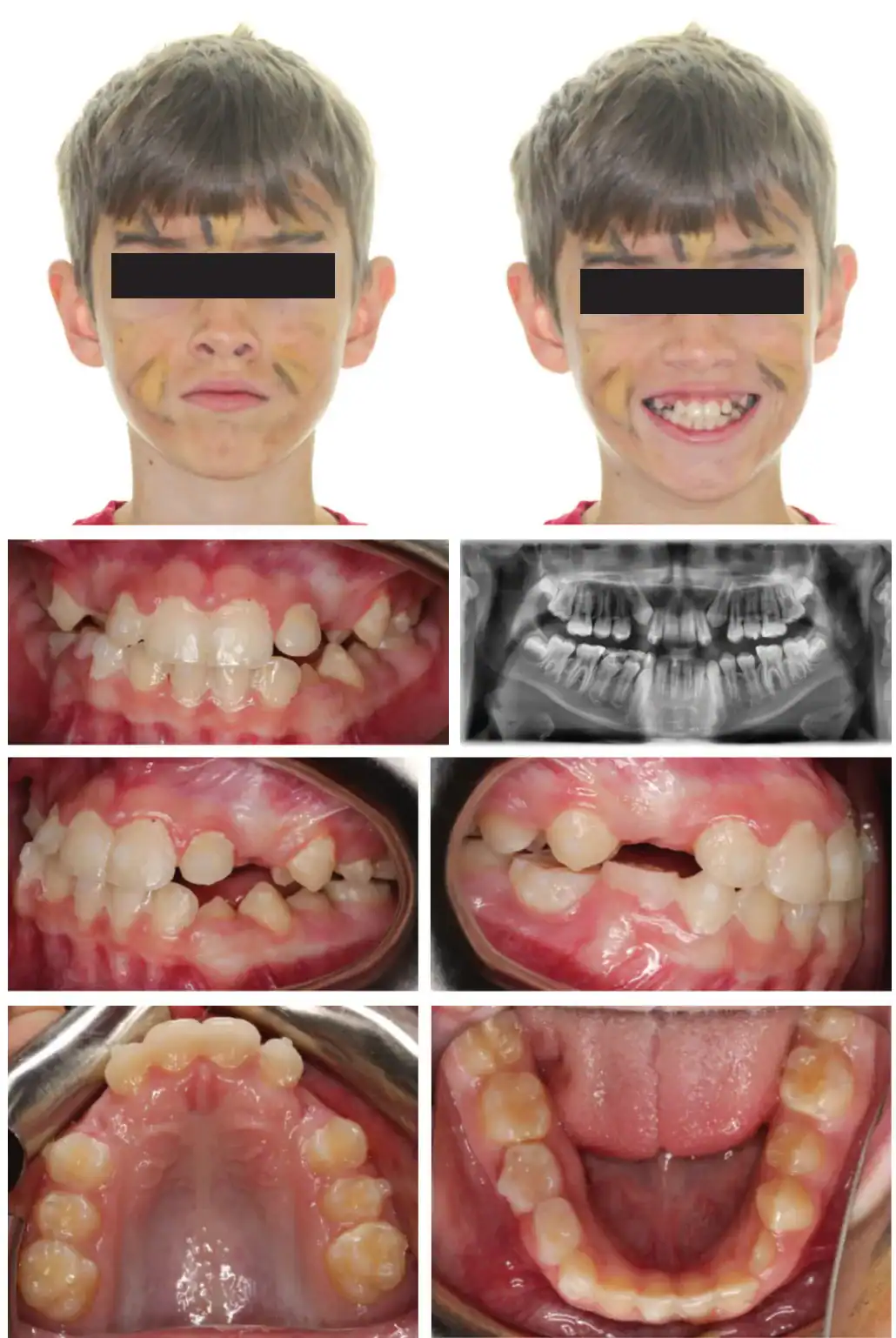 Emerick-Figure-4-JA-refinement-records-4-months-into-treatment-.png Figure 4: JA refinement records 4 months into treatment (10.11 years old). Upper and lower expanded. Refinement goals were to complete alignment and space consolidation and exaggerate U2 mesial root tip