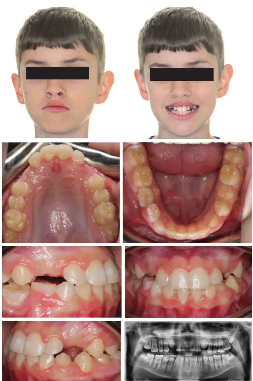 Emerick-Figure-5-JA-final-photos-—-10-months-total-treatment-time.png Figure 5: JA final photos — 10 months total treatment time. Upper and lower arches expanded and aligned, anterior spacing consolidated, midlines centered, and U2 mesial root tip exaggerated