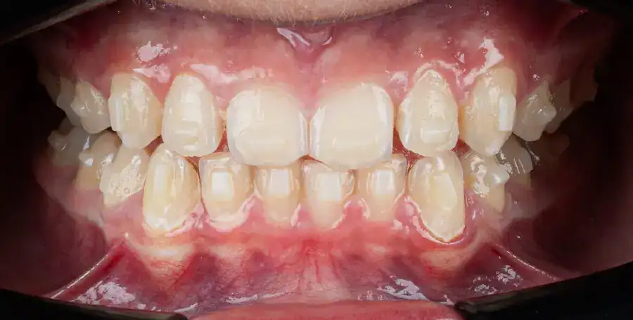 After Treatment of Class Il Division 2 Malocclusion in Growing Patients