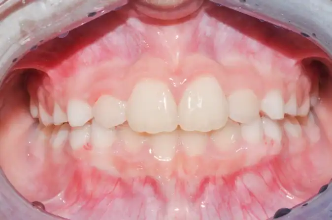 After Treatment of Before Treatment of Angel Aligner KiD