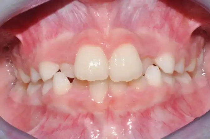 Before Treatment of Angel Aligner KiD