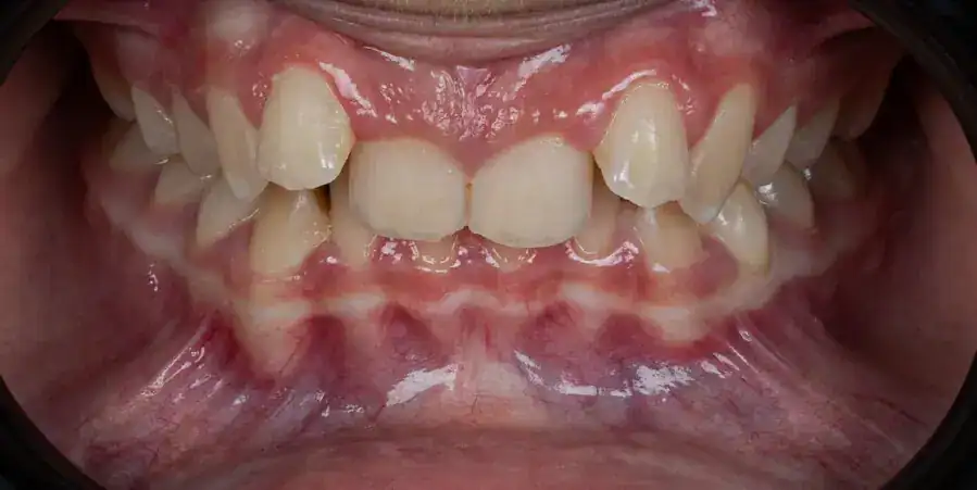 Before Treatment of Class Il Division 2 Malocclusion in Growing Patients